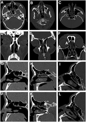 Case report: Endoscopic frontal sinus opening surgery for noninflammatory frontal sinus headache: A short case series